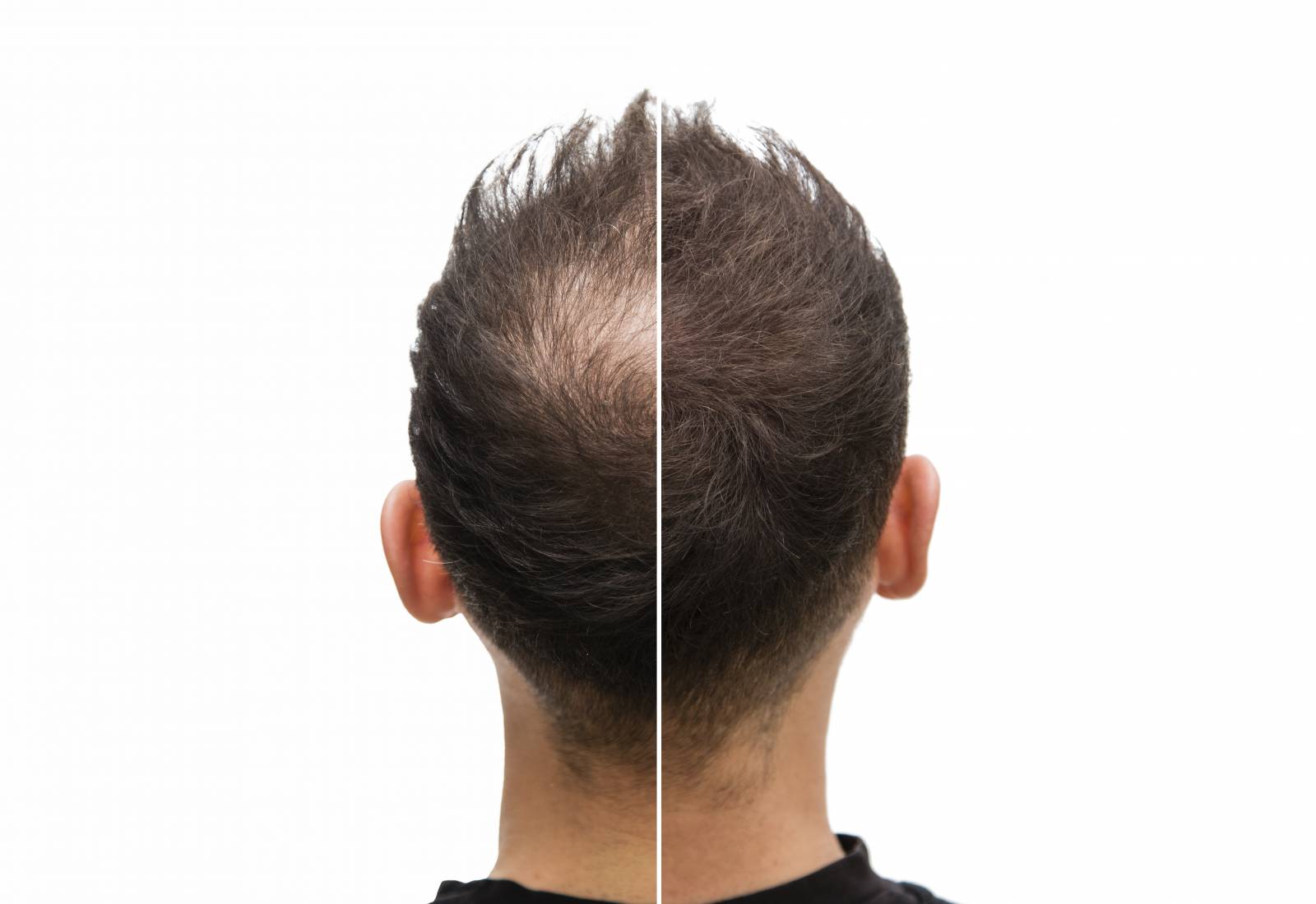 Greffe de cheveux pour un homme souffrant d'alopécie Marseille 13012
