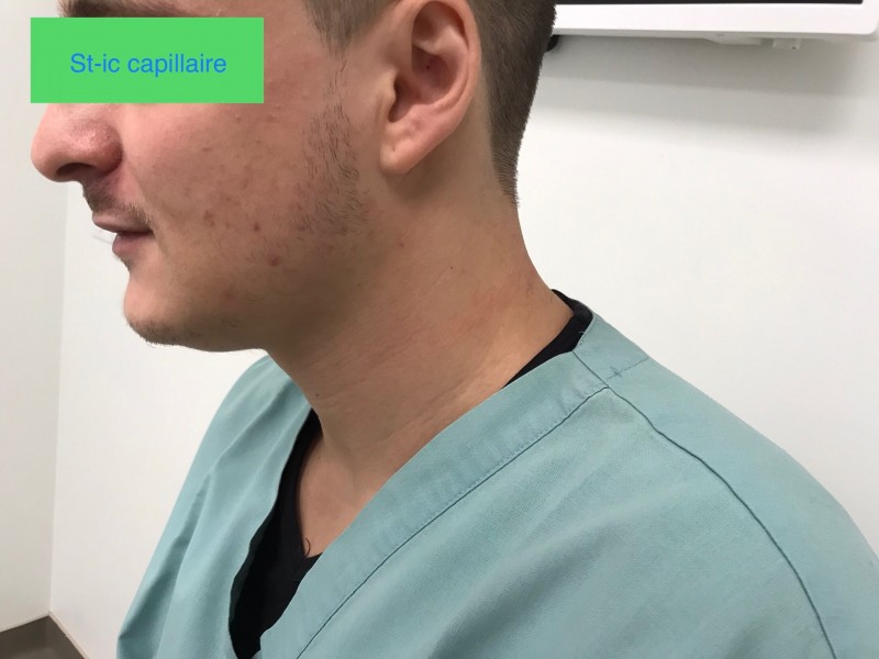 Centre d'implants capillaires pour réaliser une greffe de barbe proche d'Aix en Provence
