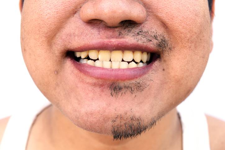 Greffe de barbe ou de moustache pour homme avec barbe clairsemée à Aix en Provence