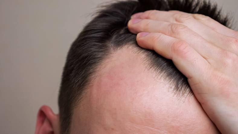 La chute des cheveux peut elle provenir d'un dérèglement hormonal? STIC Capillaire à Marseille vous répond