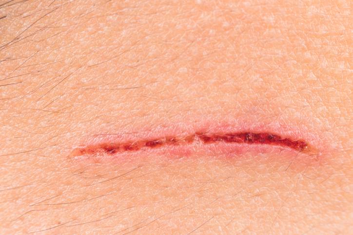 Camoufler une cicatrice avec une greffe de barbe avec STIC Capillaire à Marseille